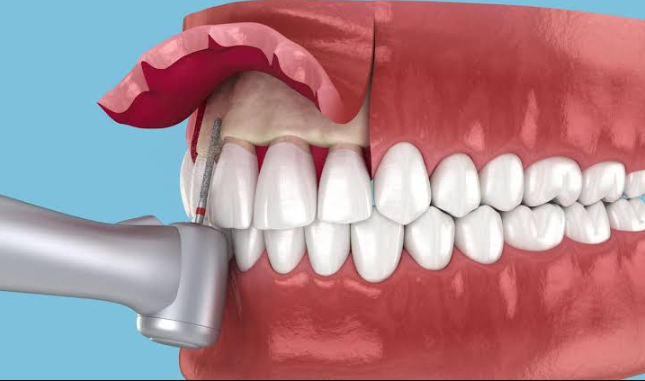 Crown Lengthening: When Periodontists Reshape Gum And Bone For Restorations
