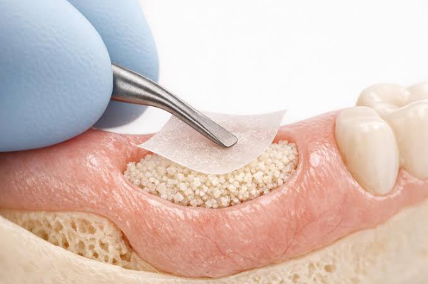 The Importance Of Papilla Support Between An Implant And A Natural Tooth